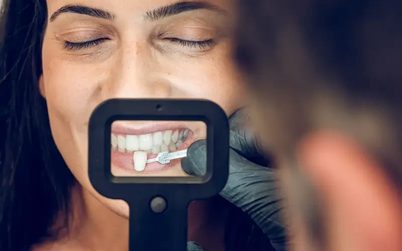 Can You Brush Veneers Once a Day A Comprehensive Guide