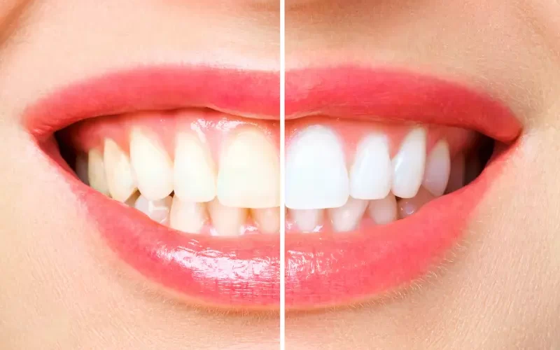 Hollywood Smile in Turkey The Ultimate Guide to Achieving a Beautiful Smile