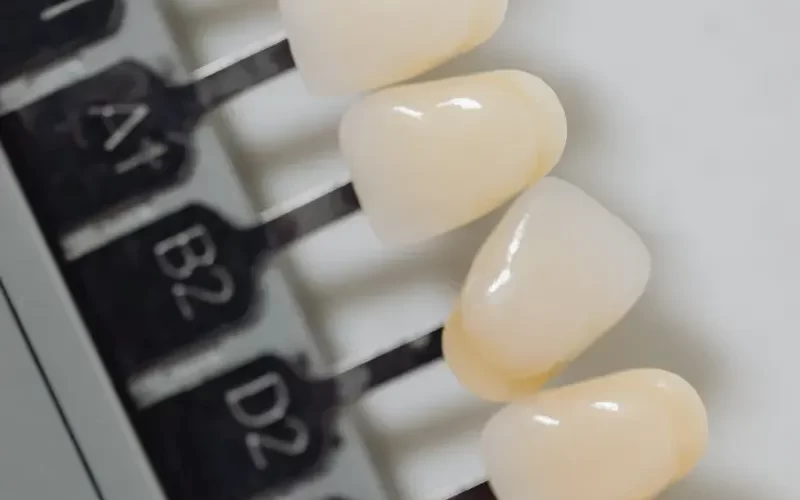 What Do Teeth Look Like Under Veneers A Comprehensive Guide