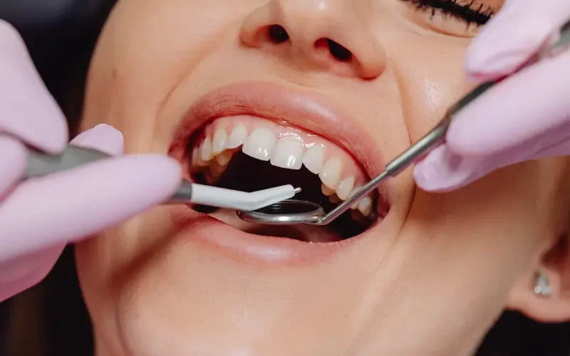 Price of Dental Bridge in Turkey The Ultimate Guide