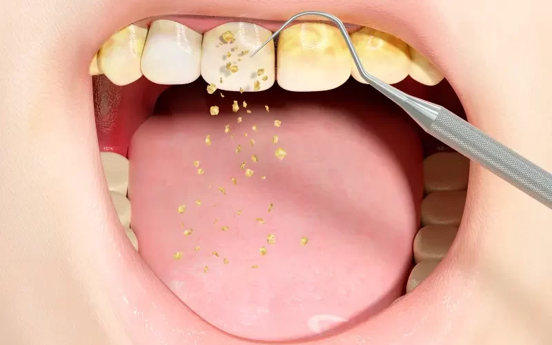 What to Expect When Removing Veneers A Guide to Your Teeth After Veneers Removed